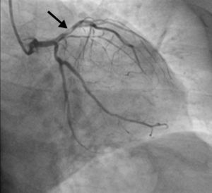 Coronary angiography showing a sub-occlusive lesion in the proximal anterior descending artery, with the appearance of a thrombus (arrow).