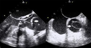 Transesophageal echocardiogram showing acute dissection of the ascending aorta.