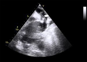 Transthoracic echocardiogram showing aortic dissection extending to the brachiocephalic trunk. Ao: ascending aorta; LA: left atrium; LV: left ventricle; white arrow: intimal flap.