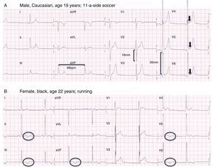 Two of the electrocardiograms (ECGs) in the study questionnaire. (A) ECG showing physiological alterations (sinus bradycardia, isolated voltage criteria for left ventricular hypertrophy and early repolarization); (B) ECG showing pathological alterations (negative T waves in all inferior leads and V5-V6), in an athlete diagnosed with hypertrophic cardiomyopathy.