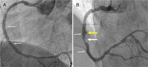 (A) Coronary angiogram of the right coronary artery showing the result of bioresorbable vascular scaffold implantation (small white arrows); (B) control angiography showing moderate in-stent restenosis (white arrow) and formation of a coronary artery aneurysm (yellow arrow).