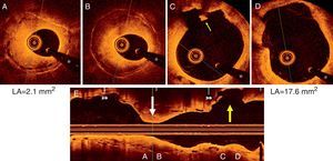 Optical coherence tomography images showing (A and B) an heterogeneous pattern of neointimal hyperplasia with a minimum lumen area (LA) of 2.1 mm2; (C and D) formation of a coronary artery aneurysm (CAA) at the proximal border of the bioresorbable vascular scaffold (BVS) with a maximum LA of 17.6 mm2. A minor rupture with associated intraluminal thrombus was visualized (small yellow arrow) (C); (E) longitudinal view depicting the segment with in-stent restenosis (white arrow) and the CAA (yellow arrow) at the edge of the BVS. * denotes wire artefact. LA: lumen area.