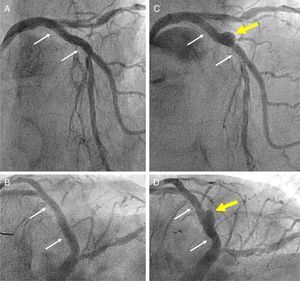 (A and B) Angiographic result after implantation of a bioresorbable vascular scaffold (BVS) in the proximal left anterior descending coronary artery (small white arrows indicate the ends of the BVS); (C and D) at nine-month follow-up formation of a coronary artery aneurysm (yellow arrow) is demonstrated in the mid segment of the BVS.