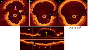 (A-D) Optical coherence tomography images of the coronary artery aneurysm (CAA) (yellow arrow) with a maximum lumen area of 27.5 mm2. Some struts of the bioresorbable vascular scaffold appear covered but largely malapposed (A, thin yellow arrow), others were extensively displaced (B), whereas no struts could be detected in other areas of the CAA (C); (D) longitudinal view. * denotes wire artefact. LA: lumen area.