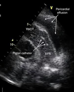 Contrast injection in parasternal short-axis echocardiographic view showing the catheter in the main pulmonary artery. MPA: main pulmonary artery; RVOT: right ventricular outflow tract.