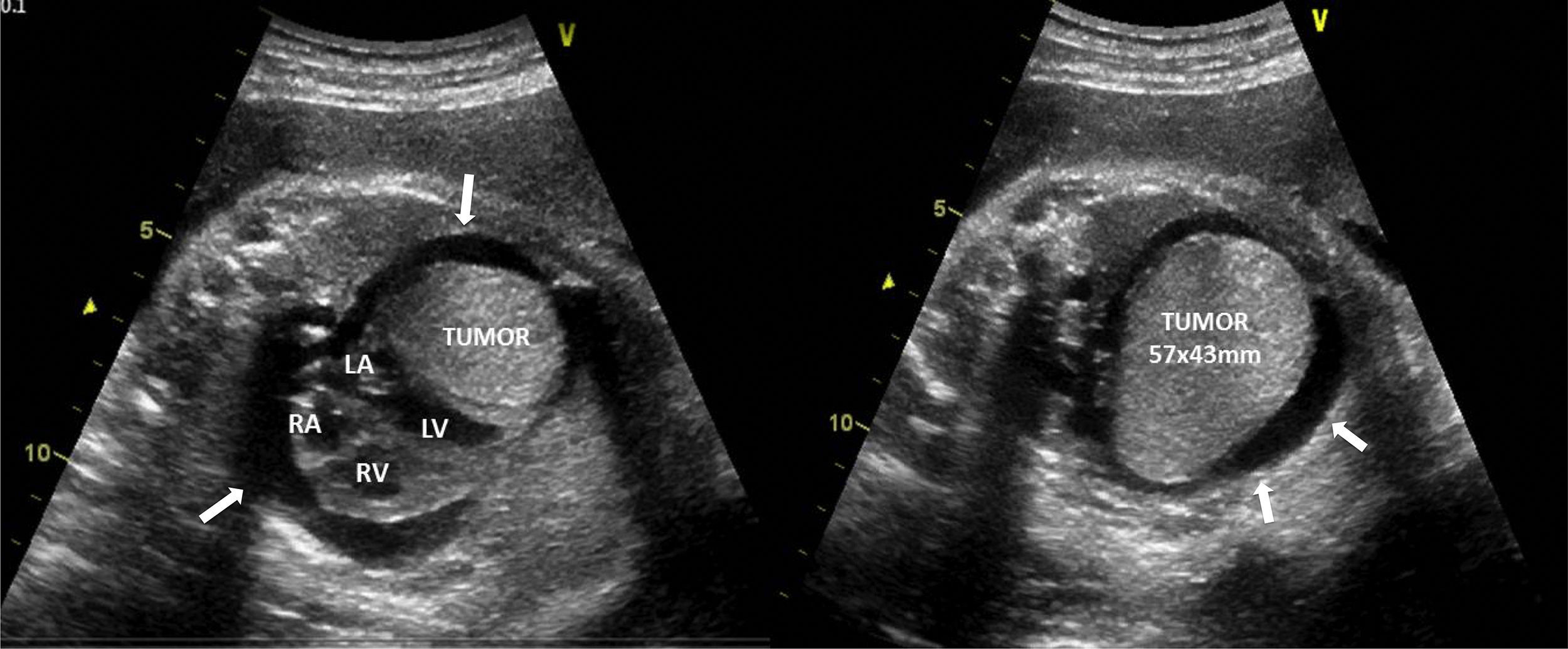 fetal-giant-cardiac-tumor-revista-portuguesa-de-cardiologia-english