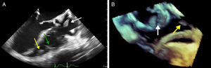 (A) Two-dimensional transesophageal echocardiogram in 3-chamber view (120°) showing vegetations on the atrial lead (white arrow) and on the tip (yellow arrow) of the ventricular lead (green arrow); (B) transesophageal echocardiogram in three-dimensional zoom mode and bicaval view (120°) showing multiple vegetations on the atrial lead (white arrow) and the ventricular lead (yellow arrow).