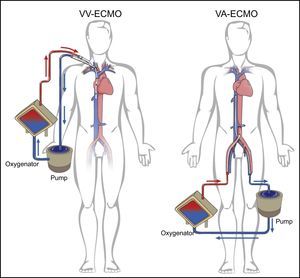 Modalities of extracorporeal membrane oxygenation. VA: venoarterial, for circulatory and/or respiratory support; VV: venovenous, for respiratory support. Adapted from Squiers et al.2