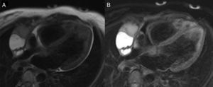 Late incidental diagnosis of intrapericardial teratoma – A case report ...