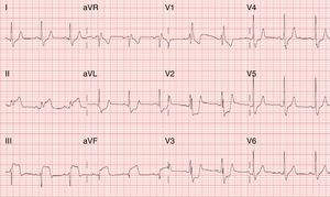 Admission electrocardiogram on second hospitalization, showing sinus rhythm, right bundle branch block, ST elevation in leads DII, DIII and aVF, and ST depression in leads V1-V3.