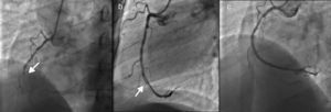 (a) Stent thrombosis in the right coronary artery (RCA) (arrow); (b) intraluminal subtraction image suggestive of RCA dissection (arrow); (c) RCA after thrombus aspiration.
