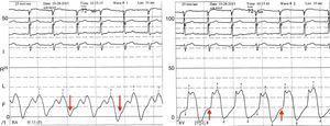 Right heart catheterization showing prominent v wave and abrupt y descent in right atrial pressure (left, red arrows) and a rapid increase in right ventricular pressure during early diastole (right, red arrows). RA: right atrium; RV: right ventricle.