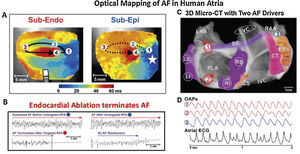 Human atrial fibrillation sustained by stable rotational sources on optical mapping.7,34 (A) Rotational AF source in right atrium, stable on endocardium yet transient on epicardium. (B) Ablation at AF source terminates AF.7 (C) Concurrent AF sources near and remote from PVs, anchored to micro-fibrosis and fiber architecture. (D) Electrograms in AF, unlike regular optical potentials, comprise noise including far-field signals.34
