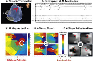 Rotational drivers for AF by multiple mapping methods. In a 67 year old woman, ablation (A) at the left atrial roof prior to PVI (B) terminates persistent AF to sinus rhythm. (C) Traditional activation mapping, (D) phase mapping using published methods38 and (E) Focal Impulse and Rotor Mapping (FIRM) each confirmed sustained rotations at the site where ablation terminated AF. Modified from references 66 and 48.