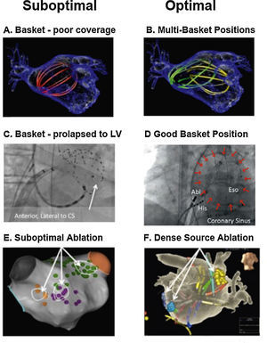 Reported pearls and pitfalls in AF source ablation. (A) Suboptimal basket position in left atrium. (B) Multi-Position Basket Mapping, the method of choice in large atria. (C) Suboptimal basket in a disappointing report, consistent with inadvertent LV prolapse – conical shape, anterolateral to coronary sinus, ventricular electrograms56; (D) good basket position covering atrium well; (E) sparse lesions over source area in disappointing series41,67; (F) dense source area lesions in a more successful series.54