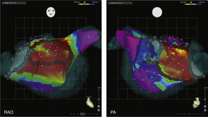 Box isolation of fibrotic areas (BIFA). Box isolation of fibrotic areas (BIFA) in a patient with recurrent atrial fibrillation despite durable pulmonary vein isolation, according to individual localization and extent of substantial left atrial fibrosis. Color coding of voltage maps: red <0.5 mV and purple >1.5 mV. Grey points represent points with no detectable electrogram at previous ablation lines, indicating pulmonary vein isolation. PA: posterior-anterior projection; RAO: right anterior oblique projection.