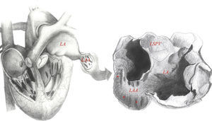 Left atrial appendage anatomy (classic ‘chicken wing’ morphology). The LAA is a remnant of the primordial embryonic left atrium, hence the presence of pectinate muscles. Note the close relationship between the LAA and the LSPV, which is very important in the setting of LAAEI during ablation for AF. Asterisks show heavy trabeculations (pectinate muscles). Abbreviations: LA: left atrium; LAA: left atrial appendage; LSPV: left superior pulmonary vein.