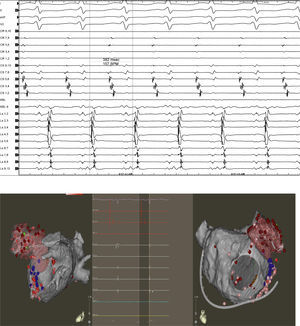 Top: Atrial tachycardia originating in the LAA with a TCL of 382 ms (15 bpm). Bottom: Electroanatomic mapping (left lateral and anteroposterior views) of the LA depicting a Lasso and ablation catheter in the LAA. Intracardiac electrograms depicting significant atrial activation delay into the LAA. The first beat shows the near and far field. The second beat illustrates the moment when the LAA is isolated (loss of neat field electrogram).