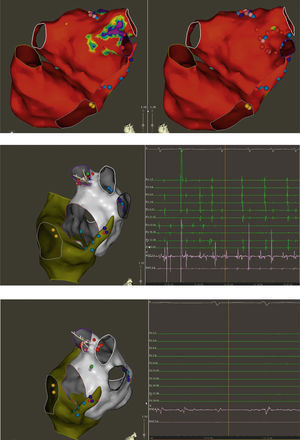 Top: Electroanatomic voltage map of a 79-year-old patient with ischemic cardiomyopathy who underwent CABG, cox-MAZE procedure and LAA ligation in 2011 for persistent AF. Patient presented to CCU with decompensated heart failure and AF with rapid ventricular response. Voltage map revealed severe right and left atrial scarring. Pre (left) and post (right) LAAEI. Note RF ablation lesions delivered at the ostium of the LAA. Middle: PentaRay catheter is in the LAA while delivering RF energy. Note that AF terminates into normal sinus rhythm. Bottom: PentaRay catheter is in the LAA showing no signals demonstrating LAAEI.