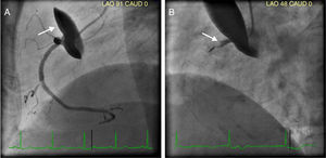 Coronary angiogram showing radiopaque area in the ascending aortic wall (Panel A) and acute occlusion of RCA (Panel B).