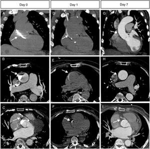 Thin (3 mm) maximal intensity projection reconstructions in coronal (first row) and transverse planes (second and third rows) of the multidetector chest CT scan performed on the first day (Panels A, B, C), on the second day (panels D, E, F) and one week later (Panels G, H, I), showing how the ascending aortic dissection and RCA occlusion and reperfusion evolved.