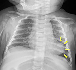 Chest X-ray showing an abnormal left-sided cardiac silhouette.