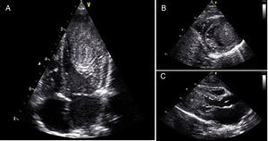 Transthoracic echocardiogram showing an intramyocardial left ventricle cardiac mass (*) involving the base of the anterolateral papillary muscle. A – apical 4-chamber view; B – parasternal short axis view; C – parasternal long axis view.