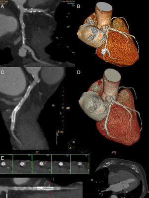 Coronary CT scan aneurysm characterisation. A) LCx maximum pixel intensity multiplanar reconstruction or MIP-MPR. B). Cardiac 3D volume rendering oriented like cranial RAO showing LCx and aneurysm. C) 3-month-follow-up coronary CT scan. LCx centreline curved multiplanar reconstruction. D) LCx 3D rendering. E) LCX straight line reconstruction derived from curved centreline. MPR (so called virtual IVUS). Axial images (red mark) revealing the stent.
