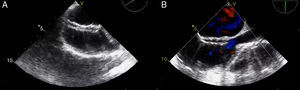 TEE images demonstrate that the occluder device was properly deployed in the middle part of the interatrial septum (A) and there was no residual shunt through it (B).