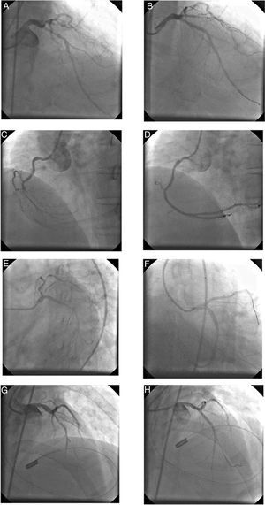 Angiograms of angioplasties and stenting performed using diagnostic catheters: angioplasty in the proximal left anterior descending (LAD) artery (A and B); angioplasty in the mid right coronary artery with clots (C and D); angioplasty of the proximal LAD in a patient in cardiogenic shock (E and F), and angioplasty of the proximal LAD in a critically ill patient (G and H).