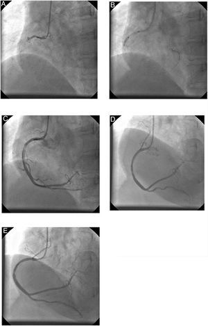 Complicated stenting of right coronary artery performed with diagnostic catheters. The proximal right coronary artery (RCA) was 100% occluded (A), and the lesion was crossed with a BMW wire with balloon support, and balloon dilatation was performed (B). A dissection was observed in the mid RCA (C), and stenting was performed from proximal to mid RCA (D and E).