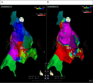 Activation (A) and voltage (B) maps of the second tachycardia. Presence of the entire tachycardia cycle around the tricuspid valve annulus. The red points correspond to the cavotricuspid isthmus line made by RF.