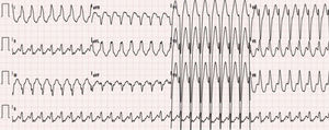 12-lead ECG: regular tachycardia, 190 bpm, widened QRS complexes (134 ms), typical left bundle branch block pattern, axis -30°, monophasic R in L1, rS in V1 and RS transition in V5, suggestive of MAP-mediated atrioventricular reentrant tachycardia. MAP: Mahaim accessory pathway.