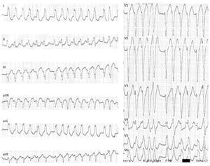 12-lead ECG: MAP-mediated pre-excited atrial fibrillation: irregular tachycardia, 230 bpm, with widened QRS complexes of varying morphologies (especially in V4 and V5). MAP: Mahaim accessory pathway.