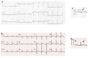 12-lead ECG: (A, A′): sinus rhythm, 70 bpm, and rS in L3; (B, B′) post-EPS with ablation: sinus rhythm, 70 bpm, and qR in L3. EPS: electrophysiology study.