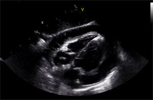 Transthoracic echocardiography: subcostal view with severe circumferential pericardial effusion.