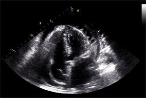 Transthoracic echocardiography: apical 5-chamber view with circumferential pericardial effusion and an appearance suggestive of fibrin aggregates.