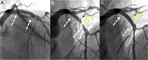 Coronary angiography. (A) A BVS was implanted in the proximal segment of the left anterior descending coronary artery two years ago (white arrows). (B) Severe restenosis was observed (yellow arrow). (C) Excellent outcome after sirolimus-eluting balloon (yellow arrow).