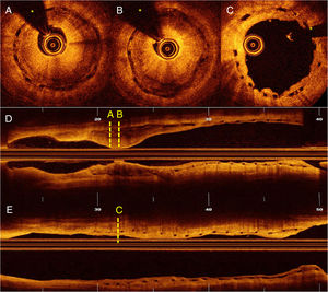 Optical coherence tomography. (A–B) Severe restenosis due to neoatherosclerosis. (C) Excellent outcome after sirolimus-eluting balloon. (D) Longitudinal view before treatment. (E) Longitudinal view after treatment. (*: wire artefact).