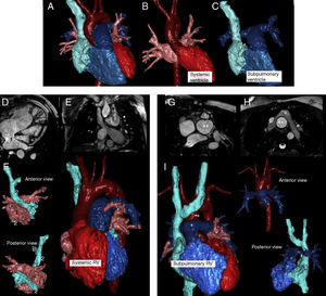 Normal heart (A-C). Chambers are color-coded; systemic chambers are red and subpulmonary chambers are blue. Atria baffles are indicated in images D to F (1, systemic baffle. 2, subpulmonary baffle. Image F, anterior and posterior view of both atria. Note the right ventricle as systemic on the whole heart rendering). In arterial switching, the abnormal position of the great vessel can be seen in images G to I (*: pulmonary artery. **: aortic root. Image I, anterior position of pulmonary artery and a subpulmonary right ventricle. Upper right, anterior view of great vessels and below, a posterior view of the subpulmonary chambers. Note the right pulmonary branch narrowing (#) between the ascending aorta and the superior vena cava).
