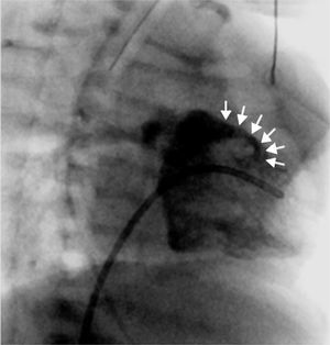 Ventriculography showing a fistula between the RV and the main pulmonary artery.