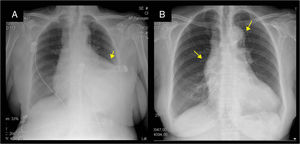 Chest radiography: (A) mediastinal enlargement and left pleural and pericardial effusion; (B) After medical treatment: thoracic aortic aneurysm.