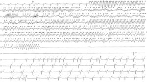 Night-time Holter tracing documenting prolonged polymorphic ventricular tachycardia and ventricular fibrillation, followed by ventricular asystole and subsequent resumption of sinus rhythm.