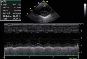 Initial echocardiography showing left ventricular ejection fraction of 36% and left ventricular systolic function of 17%.