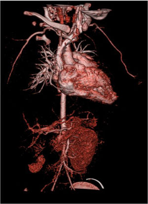 Computed tomography angiography showing vascularization only in the inferior pole of the right kidney.