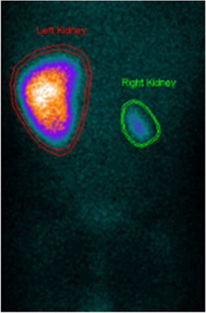 Dimercaptosuccinic acid scan showing small right kidney and almost complete functional exclusion (4.5%).