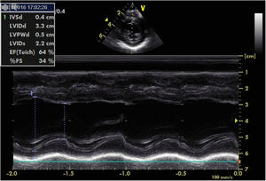 Echocardiography showing left ventricular ejection fraction of 64% and left ventricular systolic function of 34%.
