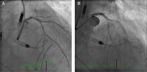 Case 2. (A) The right anterior oblique cranial view shows distal left main coronary artery (<span class=