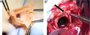 (A) Preparation of an aortic valve homograft prior to implantation during surgery. (B) Visualization of the vegetation removed from the aortic prosthesis.
