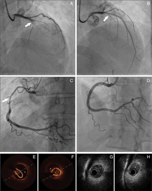 Spontaneous coronary artery dissection